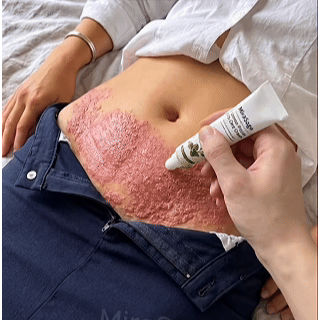 Advanced Psoriasis & Eczema Relief Cream - QZE